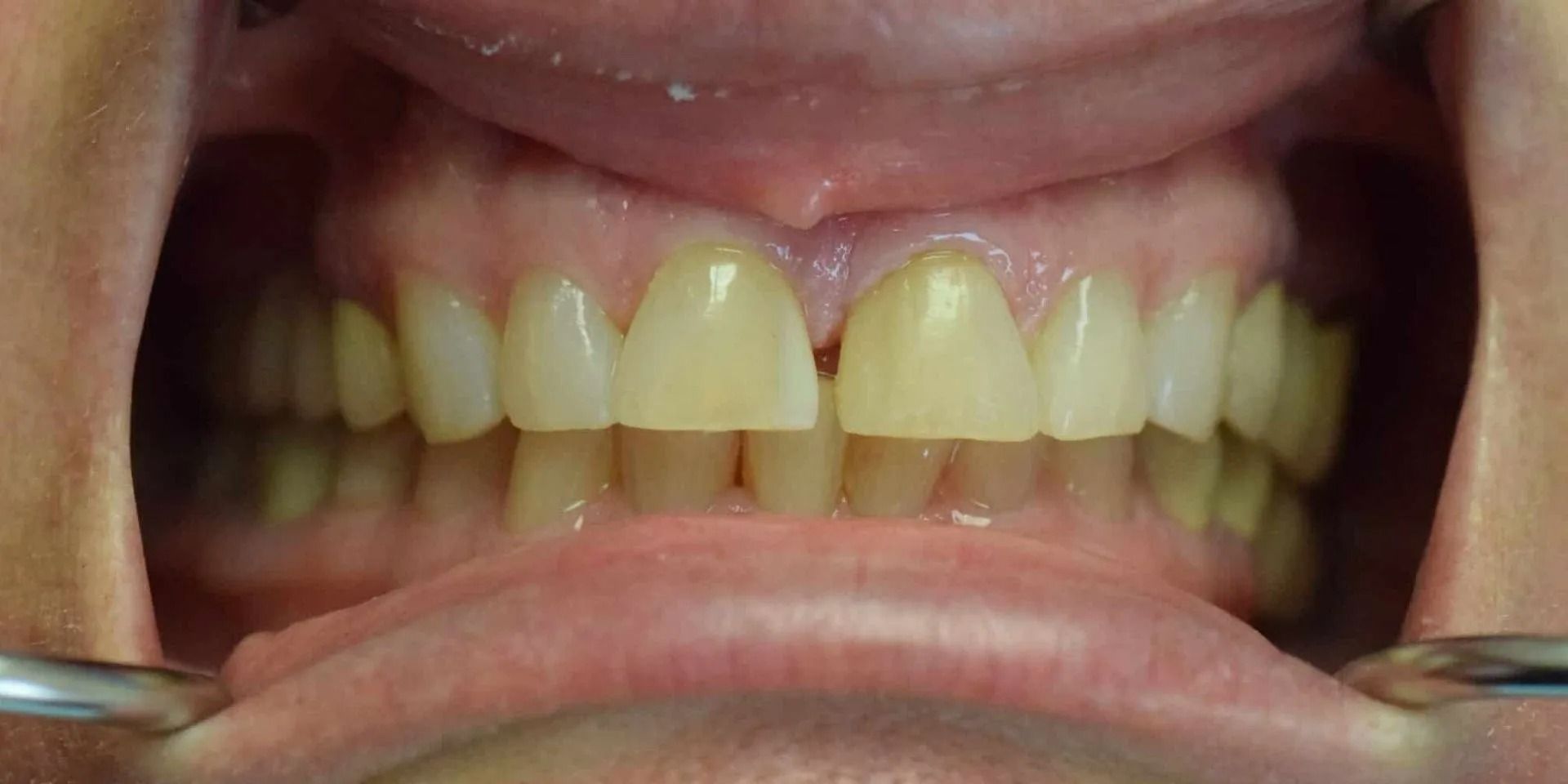 Close-up of teeth with a gap, yellowed, and visible gums, held open by a dental tool.