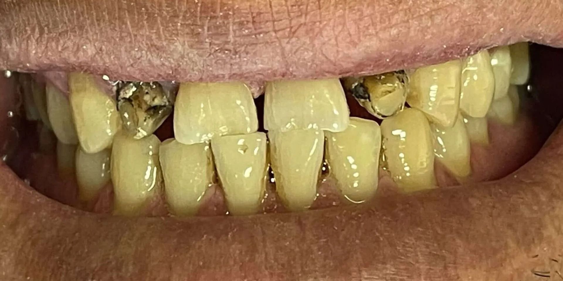 Close-up of a person's mouth, showing yellowed teeth with dental fillings and decay.