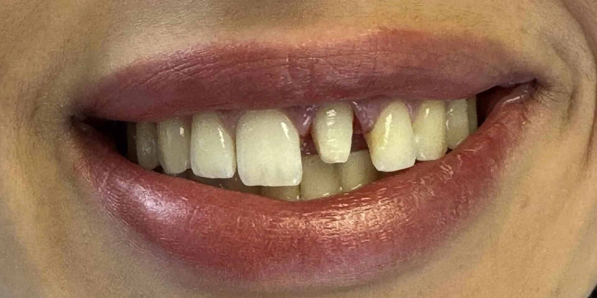Close-up of a smiling mouth with noticeable gap between the front teeth. Lips are painted red, teeth are slightly yellow.