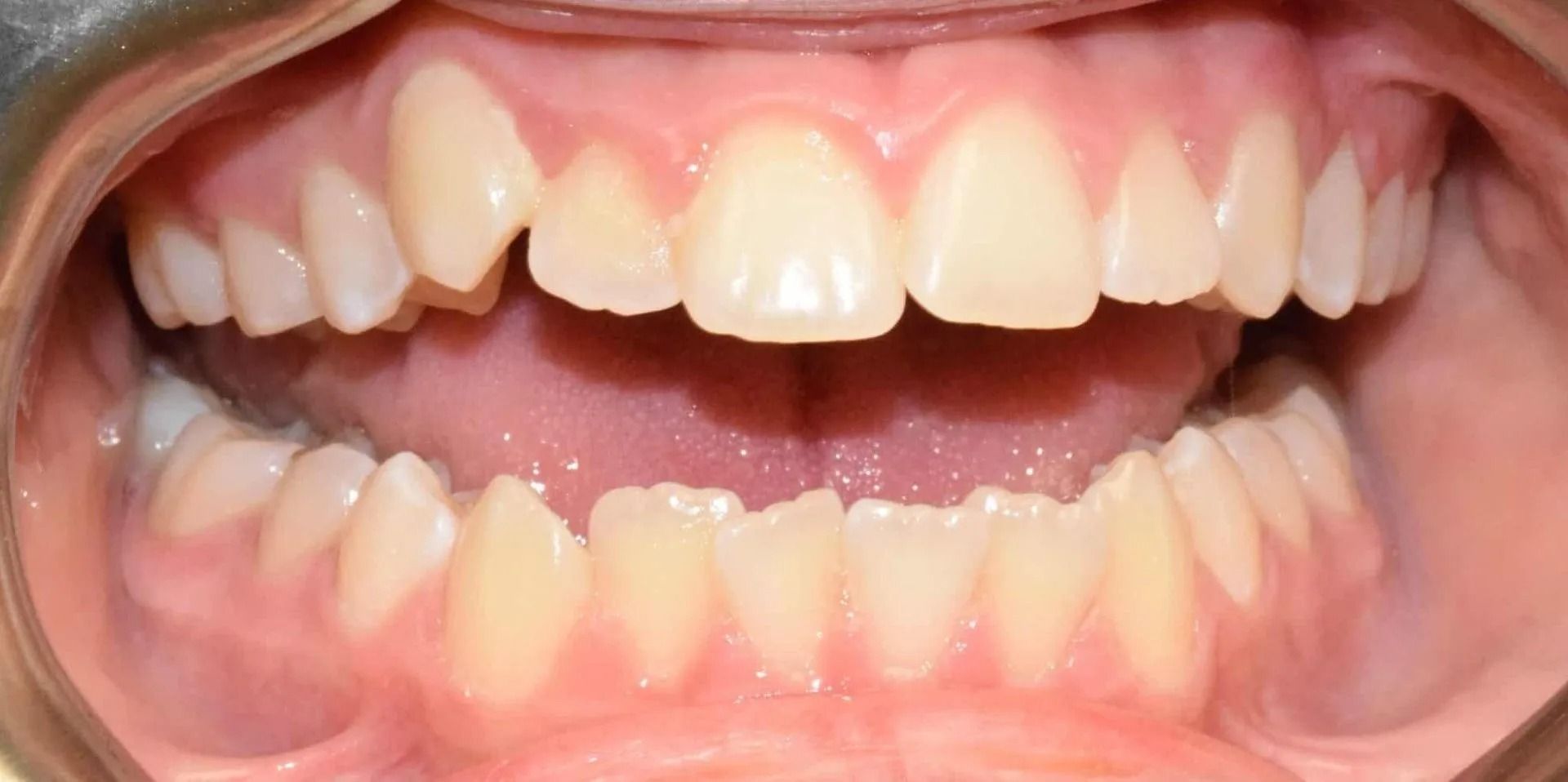 Close-up view of teeth in a mouth, showing slight misalignment and a gap between the front teeth.