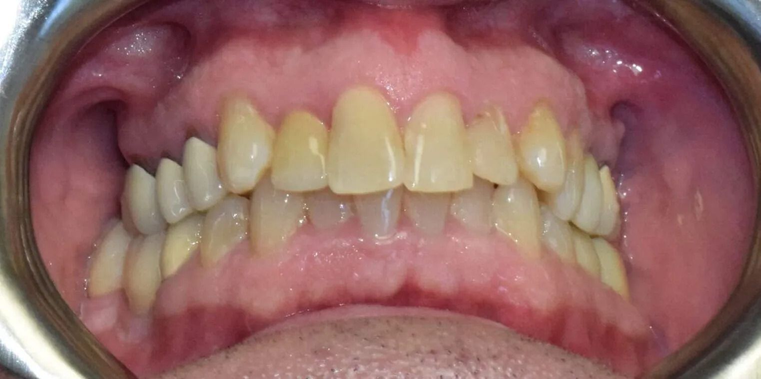 Dental examination of teeth showing yellowing and some misalignment.