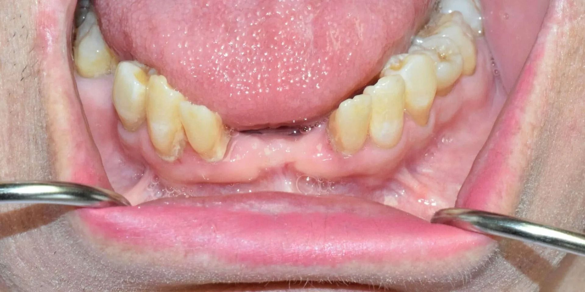 Mouth with visible teeth and tongue, dental tool retracting the lip.