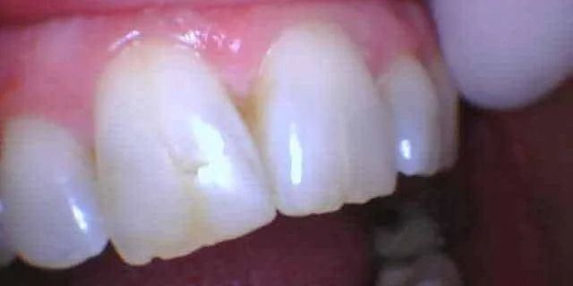 Close-up of teeth, highlighting a chipped front tooth. Pink gums visible.