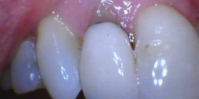 Close-up of teeth with a slightly visible reddish gum. The teeth appear clean and white.