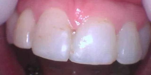 Close-up of human teeth, showing a smile. Teeth are white with some brown spots. Pink gums visible.