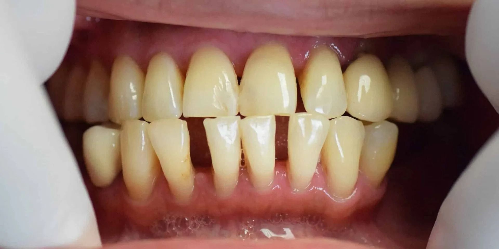 Close-up of human teeth, showing a full set of both upper and lower teeth, some slight yellowing.