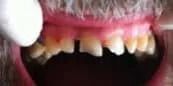 Close-up of teeth. Yellowed teeth with gaps. Pink gums, dark mouth. White object to the left.