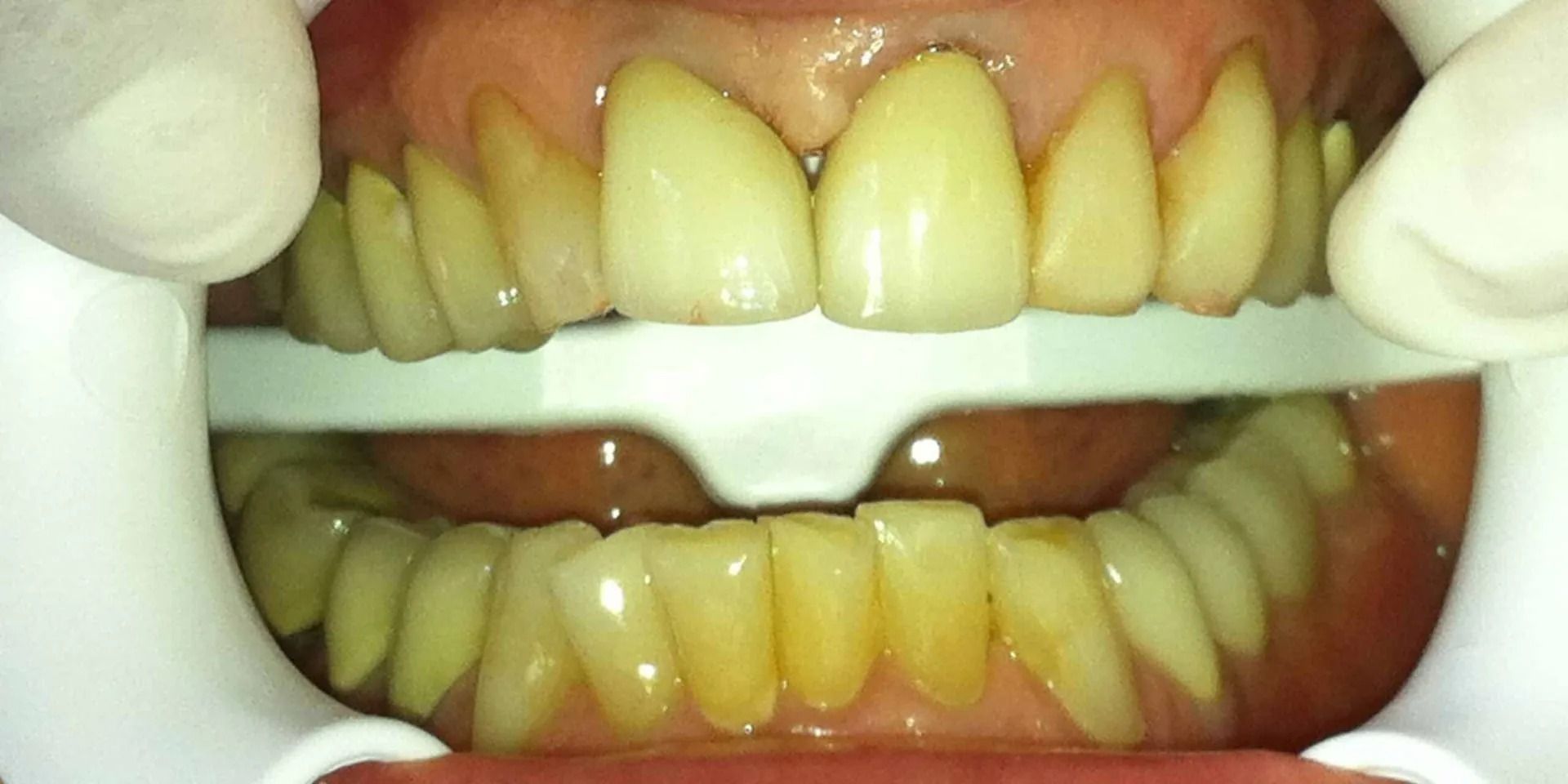 Dental examination: Open mouth with teeth visible, white retractor in place, yellowish teeth, red gums.