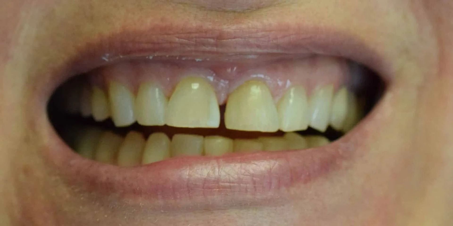 Close-up of a person's mouth with slightly yellowed teeth and a gap between the two front teeth.