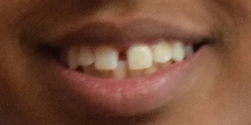 Close-up of a person's smiling mouth showing teeth with a gap between the front teeth.