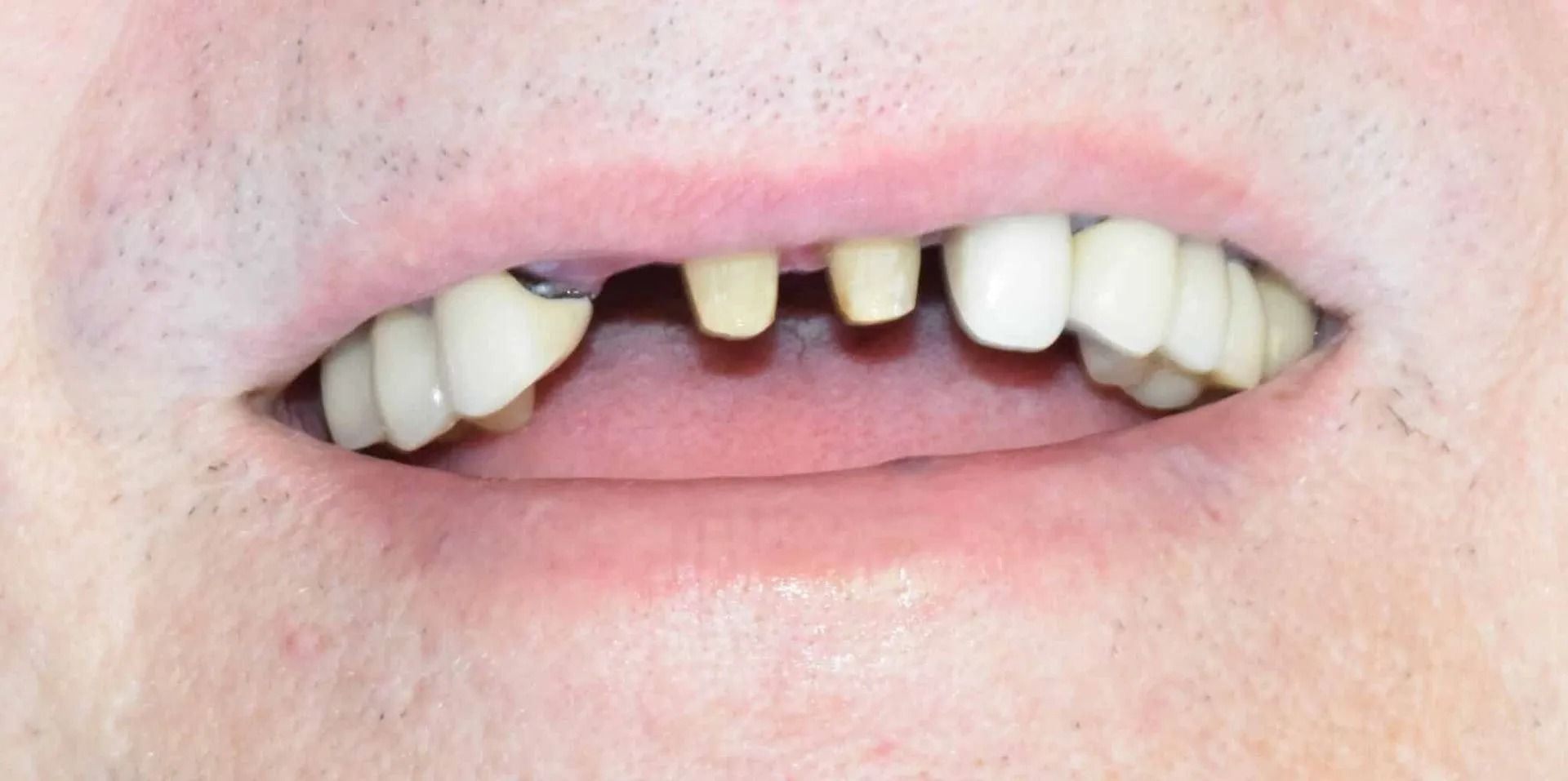 Close-up of a person's mouth. Several teeth are missing, with visible teeth and gums.