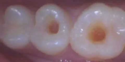 Close-up of three teeth with small brown spots in the centers of two.