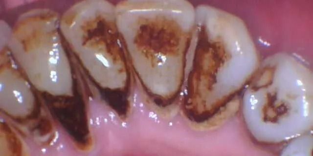 Close-up of teeth with dark brown staining, possibly due to poor oral hygiene.