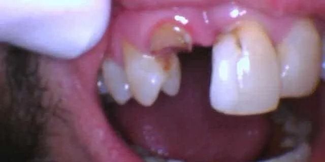 Close-up of a mouth with a missing tooth and several damaged teeth.