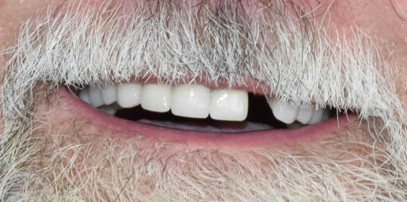 Close-up of a man's mouth with a missing front tooth and a grey beard.