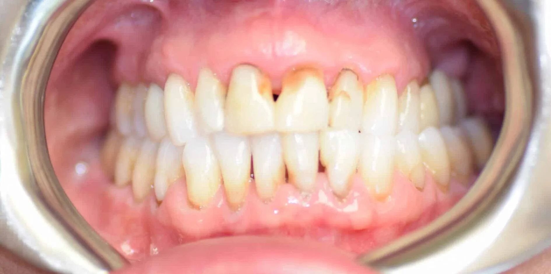 Mouth with teeth held open by dental tools. Teeth appear discolored, with gaps and yellowing. The gums are pink.