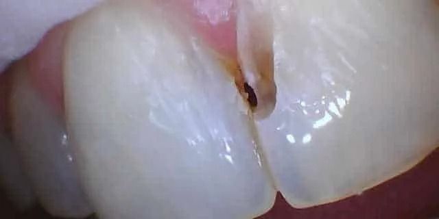 Close-up of human teeth, showing a small cavity or decay, a gap between teeth, and pink gums.