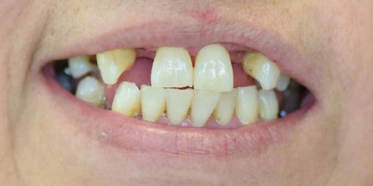 Close-up of a person's mouth with several missing, crooked, and discolored teeth.