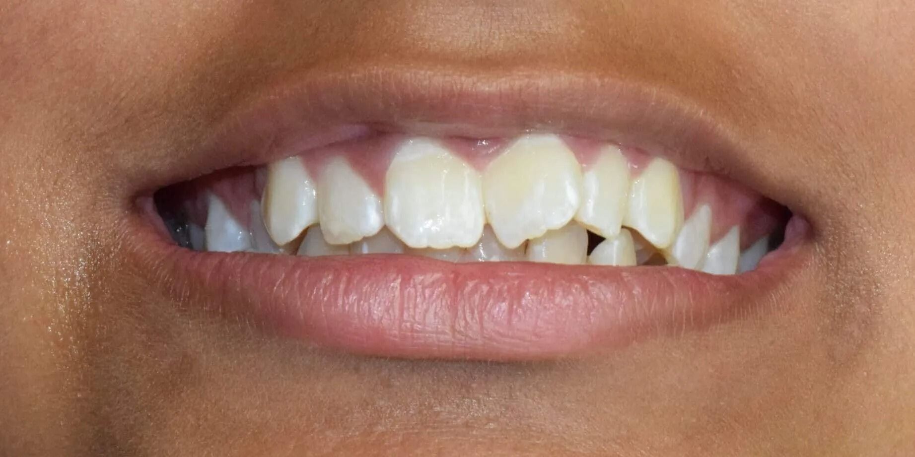 Close-up of a person's slightly open mouth and teeth. Teeth are slightly yellow and crooked. Skin is tan.