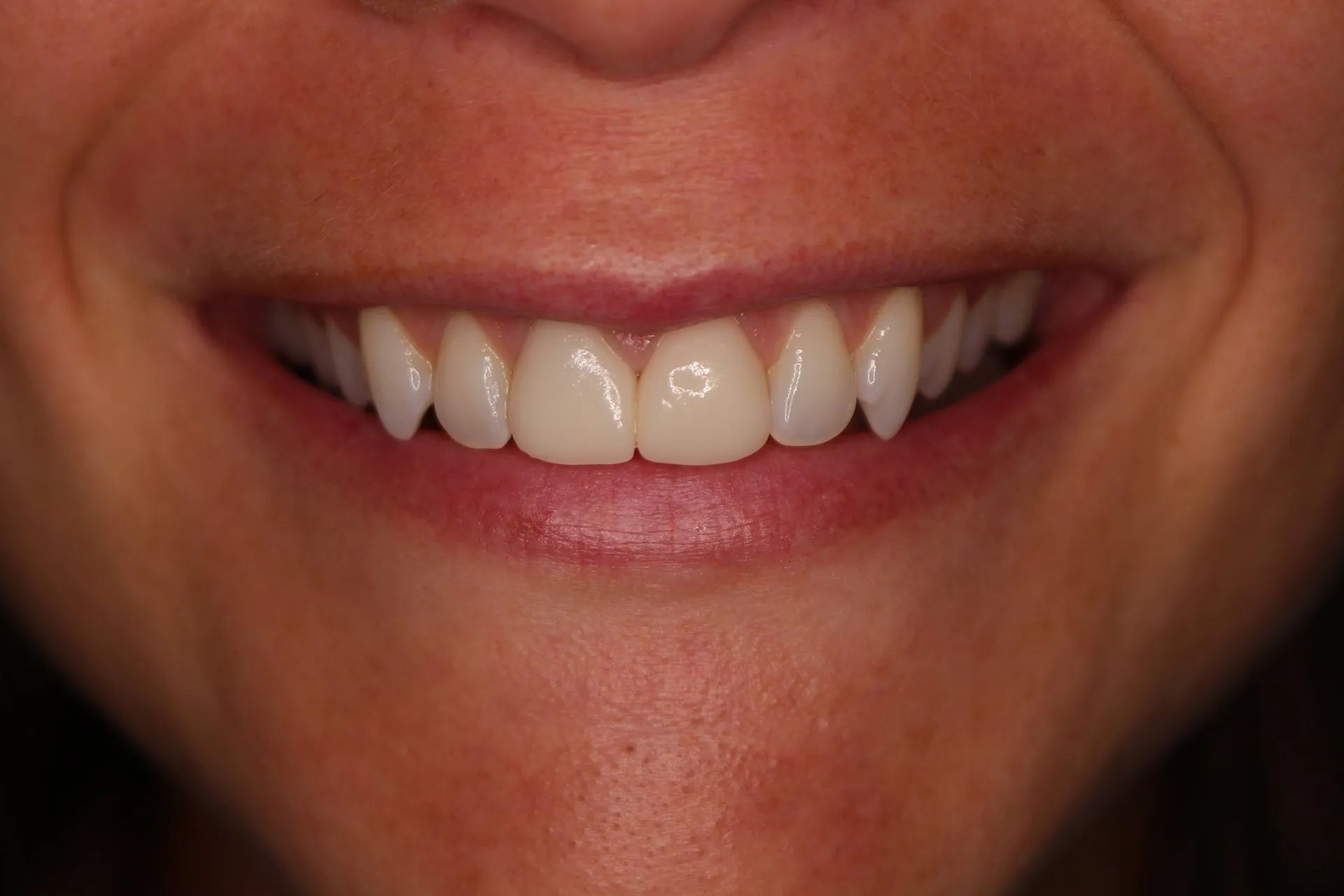Close-up of a smiling mouth with white teeth and glossy lips