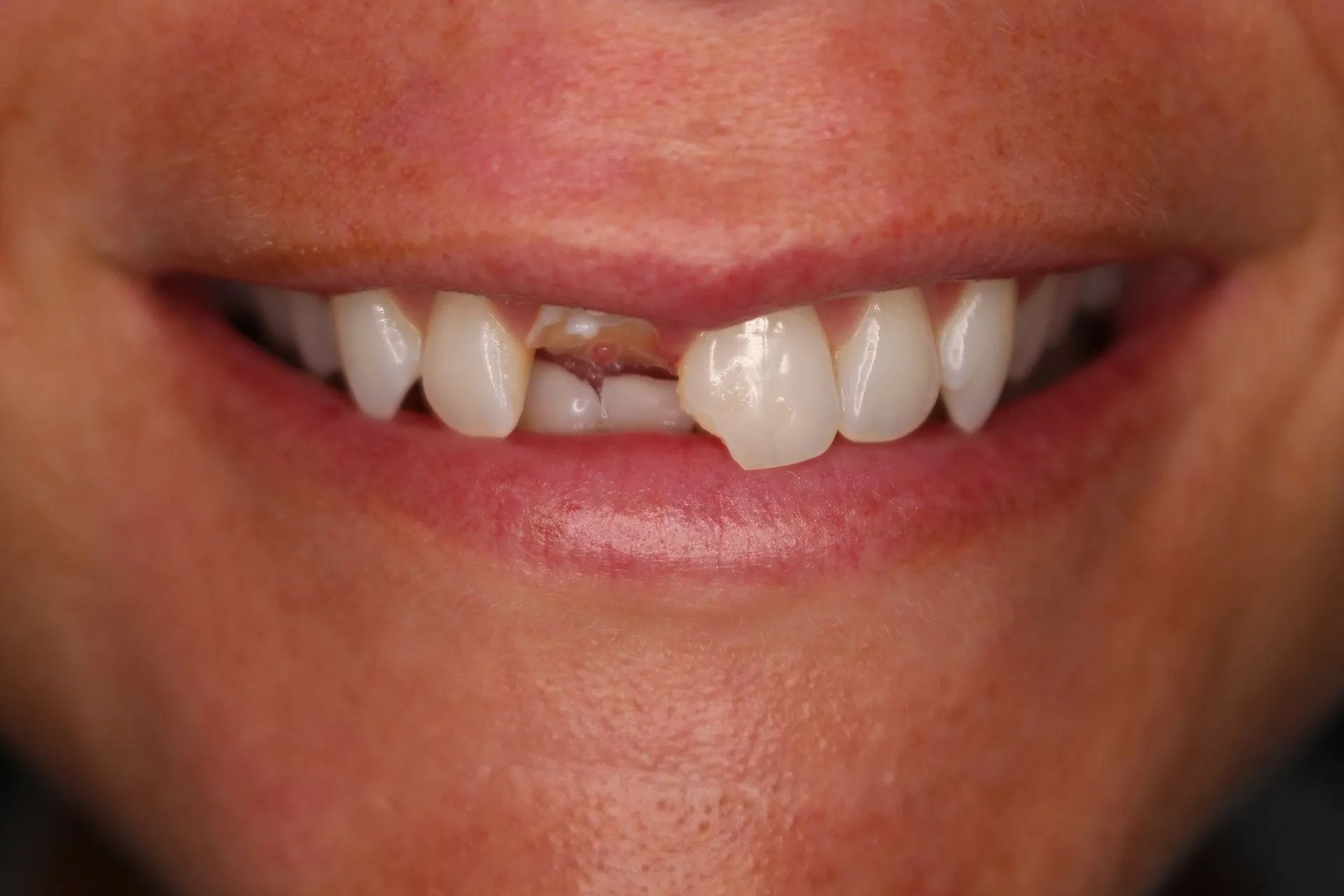 Close-up of a smiling mouth with crooked front teeth and a missing tooth