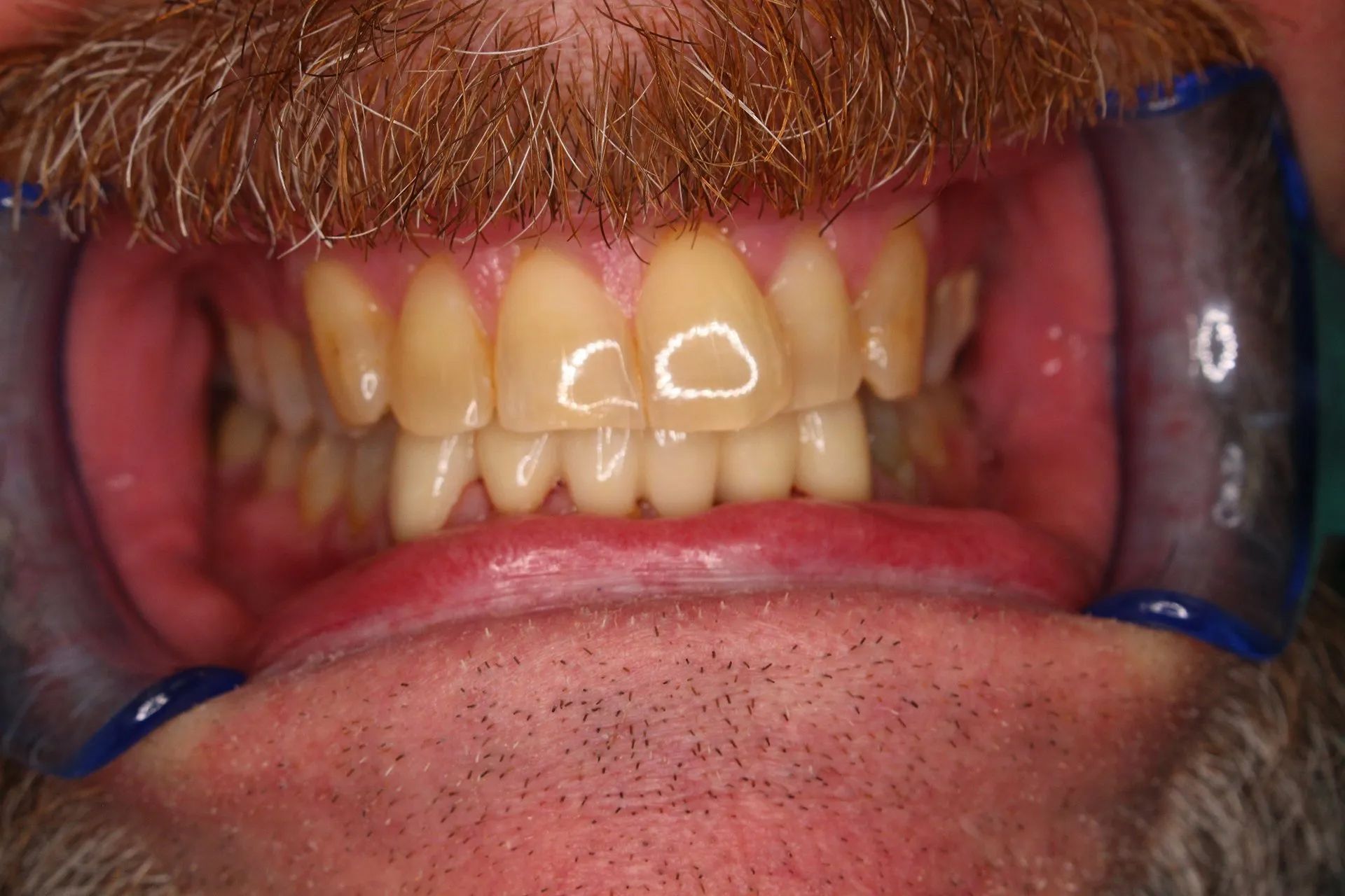 Close-up of teeth with a dental retractor, showing front upper teeth and gums.