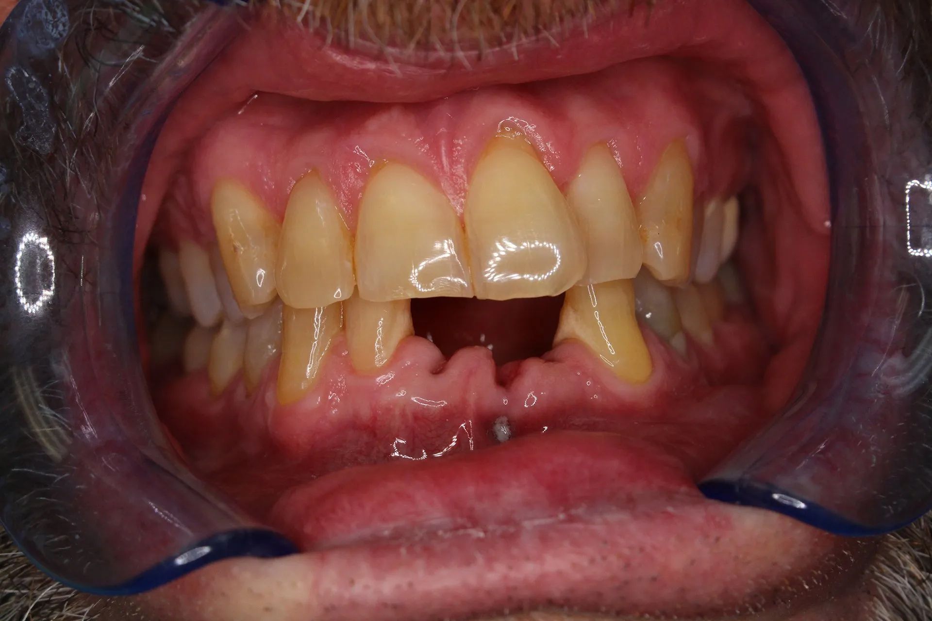 Close-up of mouth showing a large gap in the upper front teeth and visible dental discoloration