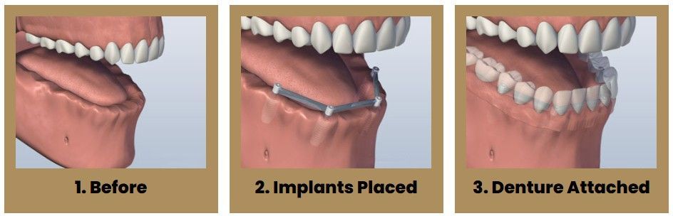 Three pictures of a person 's teeth before and after dental implants