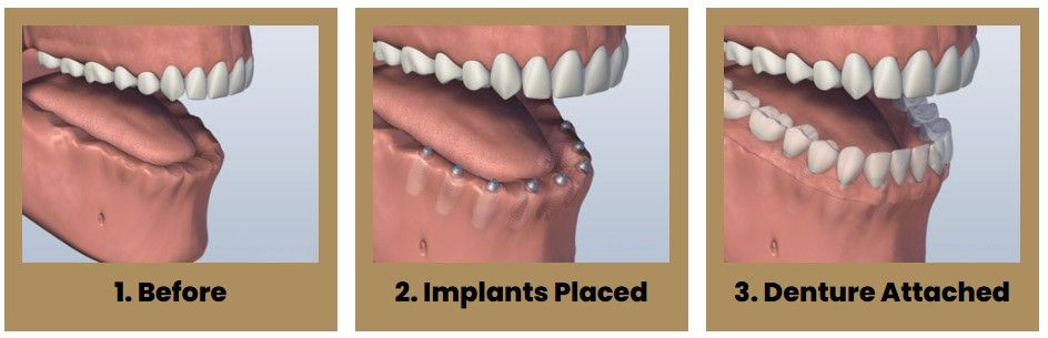 Three pictures of a person 's teeth before and after dental implants