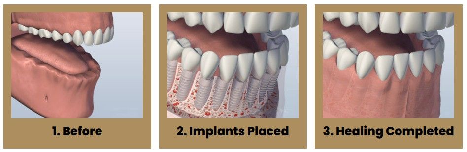 Three pictures of a person 's teeth before and after dental implants