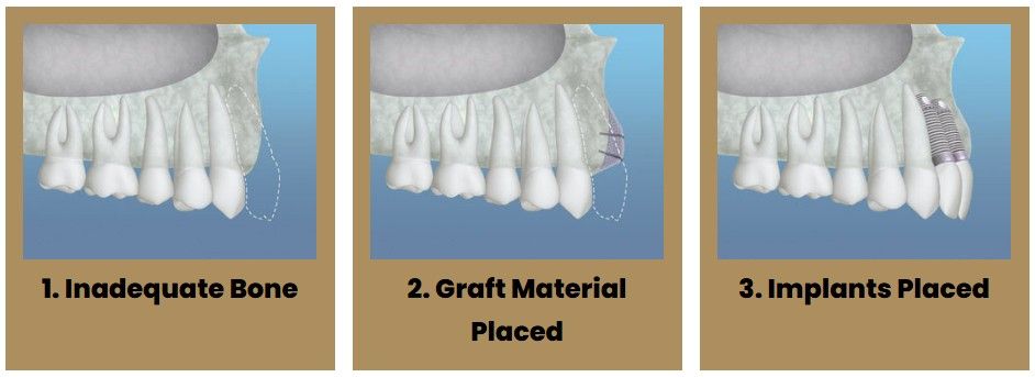 Three pictures of a tooth with the words inadequate bone graft material placed and implants placed