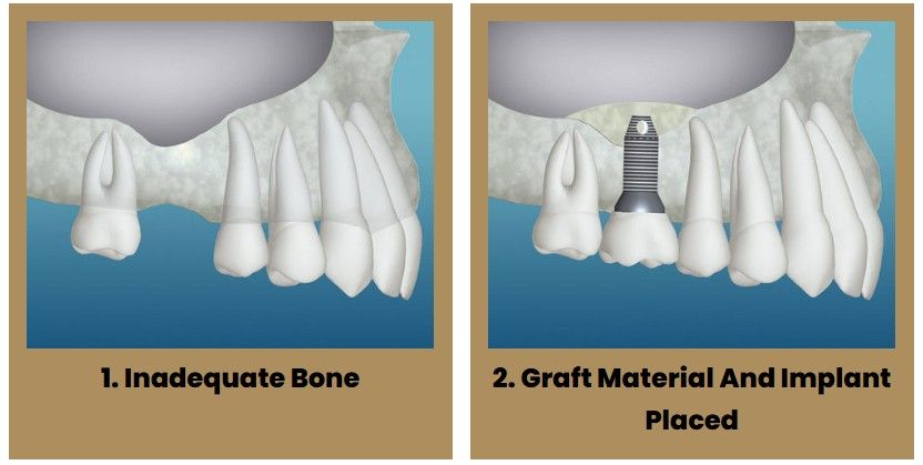 A picture of an inadequate bone and a picture of a graft material and implant placed