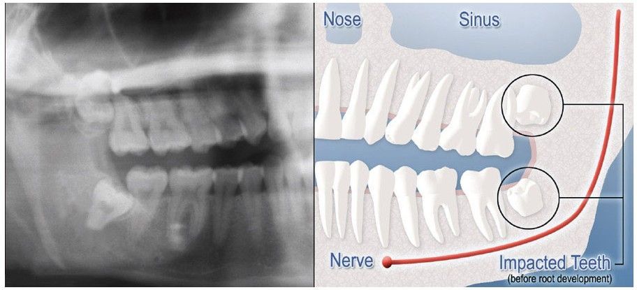 An x-ray of a person 's teeth and a diagram of the teeth