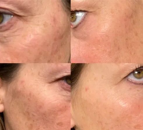 Before and after photos of a woman's face, showing reduction of wrinkles and skin discoloration after treatment.