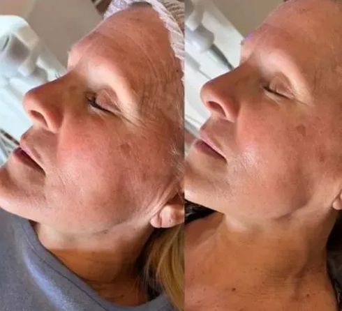 Side-by-side comparison of a woman's face, before and after a skin treatment. Her wrinkles and age spots are reduced.