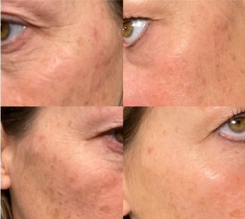 A woman's face is shown before and after a treatment.