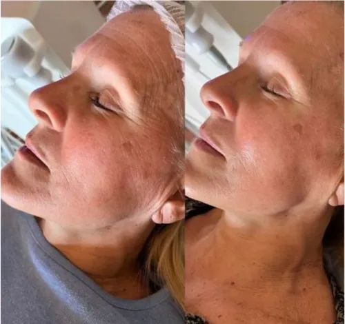 A woman's face is shown before and after a treatment.