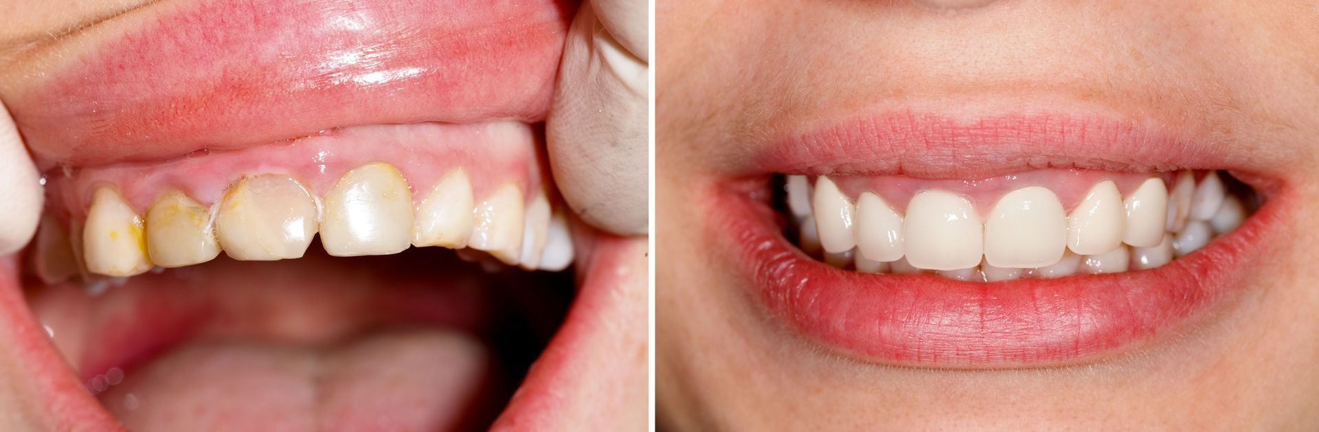 dental crowns
