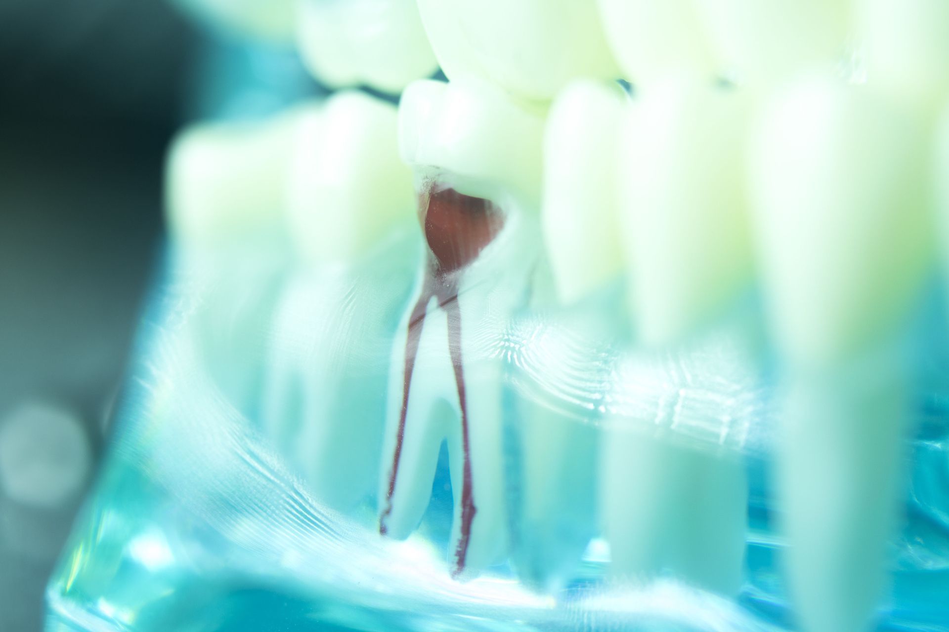 root canal therapy