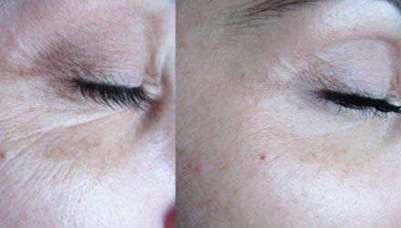 Wrinkle treatment after and before 