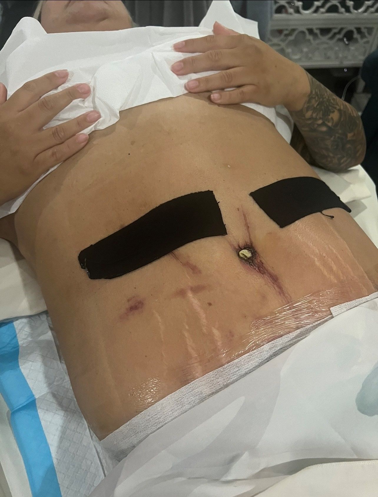 Person's abdomen after surgery, with bandages over incisions and surgical tape.