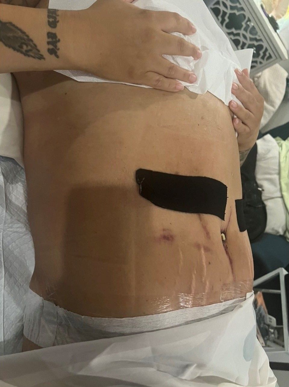 Abdomen with surgical incisions and dressings; someone holding a tissue over it.
