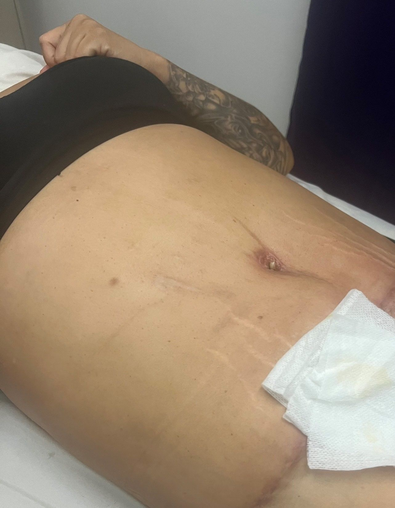 Person lying down with a bandage on abdomen and a healing surgical wound. Skin is visible.