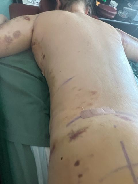 Person's back with surgical markings and bruising, lying on a green surface. Darker markings around the body.