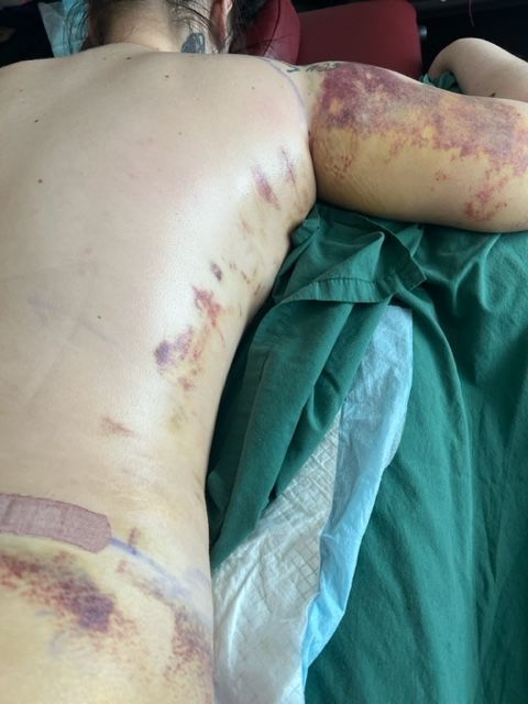 Person's back and arm with extensive bruising, possibly from injury or medical procedure.