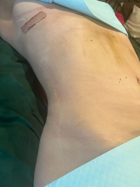 Torso with surgical tape, post-op view, showing pale skin, bruising, and minor markings, positioned on green fabric.