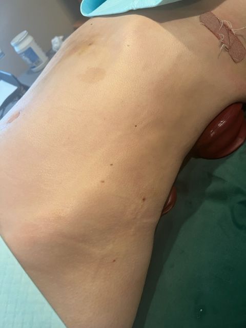 Person's side lying on a medical surface with a small pillow. The skin is pale with some dark marks, and a bandage is visible.