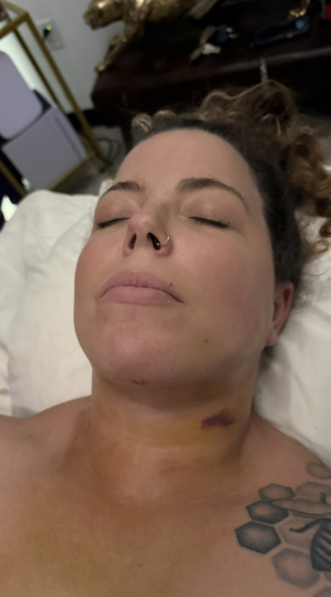 Woman lying with closed eyes; bruised neck, yellow discoloration; tattoo on shoulder.