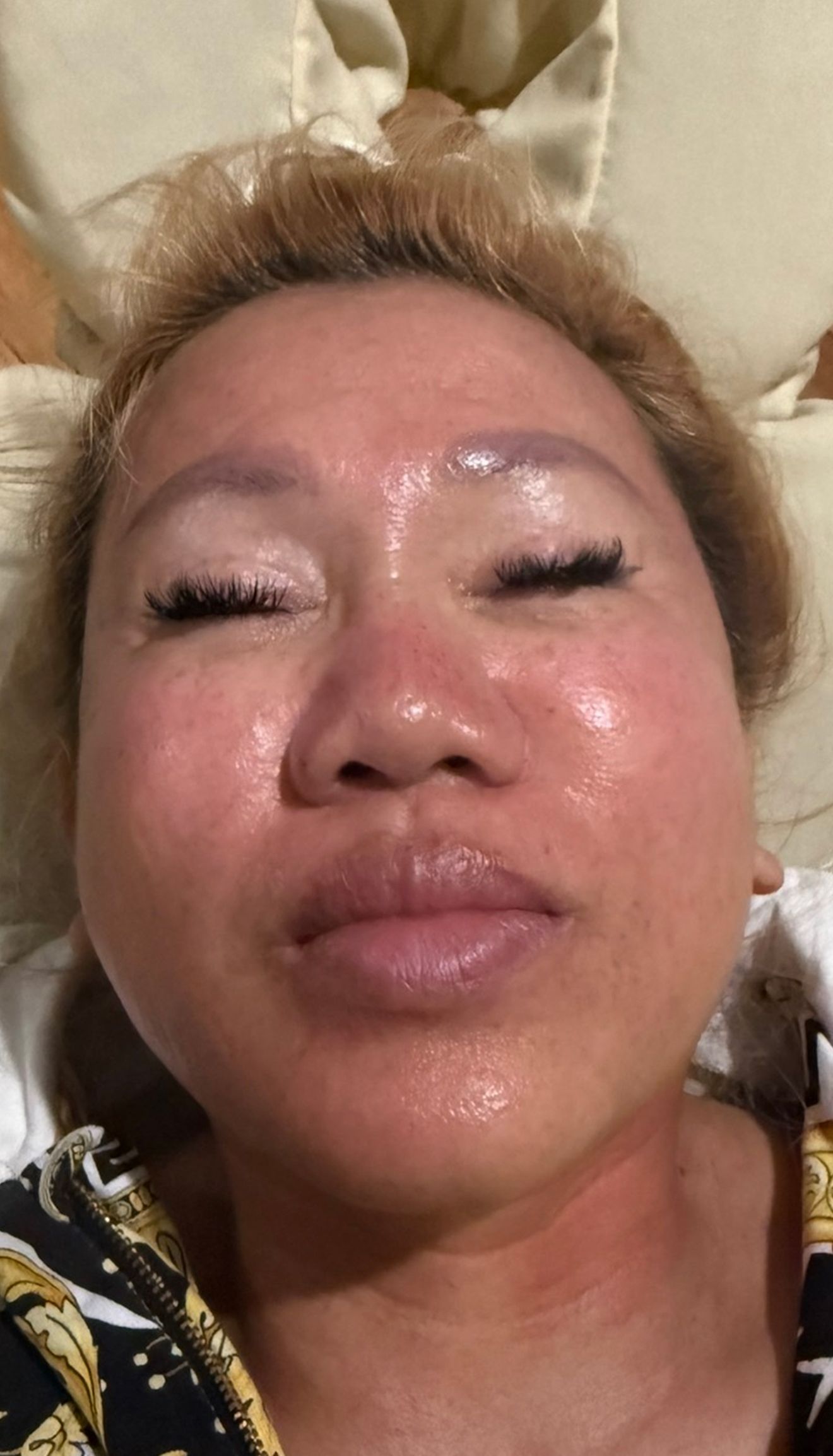After 55-Year Old Woman First Microneedling Treatment