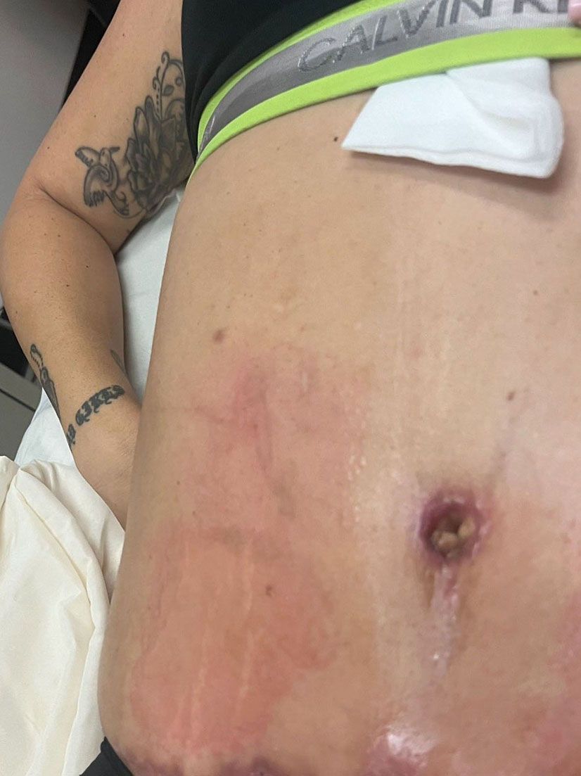 Abdomen with a stoma, skin discoloration, and visible stitches or incisions.